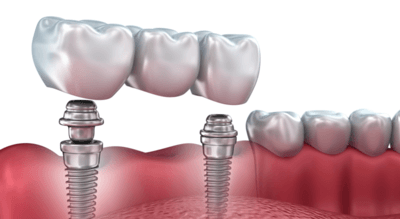 Curriculum for implant prosthetics study club